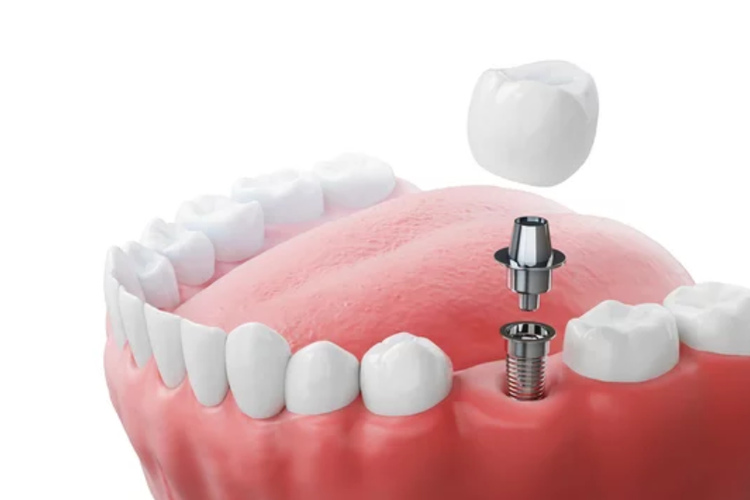 316L MIM Dental Implants